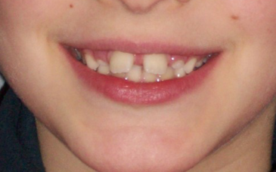 Perché curare i denti storti da bambino e da grande ?