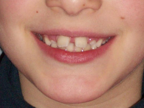 Perché curare i denti storti da bambino e da grande ?